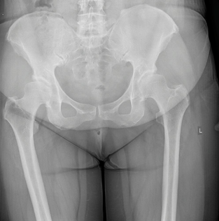 Ασθενής 6 - Πριν από την Ταυτόχρονη Αμφοτερόπλευρη Αρθροπλαστική Ισχίου