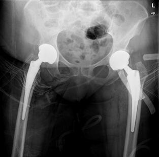 Ασθενής 7 - Μετά από την Ταυτόχρονη Αμφοτερόπλευρη Αρθροπλαστική Ισχίου