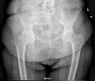 Ασθενής 7 - Πριν από την Ταυτόχρονη Αμφοτερόπλευρη Αρθροπλαστική Ισχίου